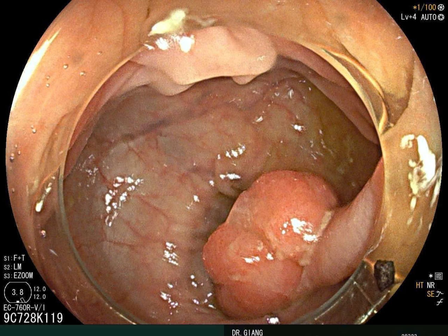 Cô Liên từng được chẩn đoán có polyp trong đại tràng