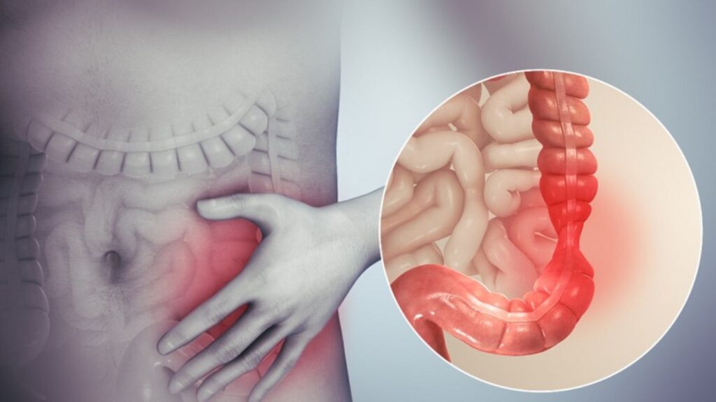 Hội chứng ruột kích thích IBS là gì? Nguyên nhân, triệu chứng và cách kiểm soát