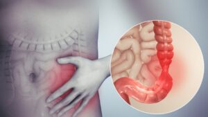 Hội chứng ruột kích thích IBS là gì? Nguyên nhân, triệu chứng và cách kiểm soát