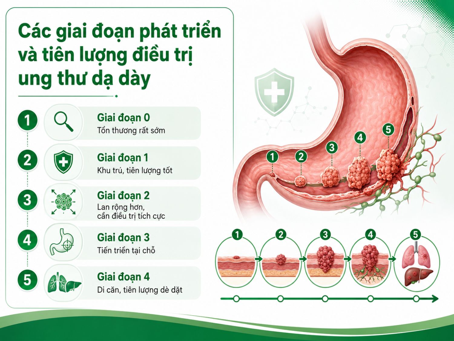Ung thư dạ dày được phân chia theo từng giai đoạn từ rất sớm đến di căn. Phát hiện càng sớm thì cơ hội điều trị hiệu quả càng cao, vì vậy người có yếu tố nguy cơ nên chủ động tầm soát định kỳ.