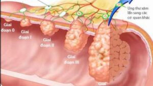 Các giai đoạn ung thư dạ dày và tiên lượng điều trị: Bác sĩ tiêu hóa giải đáp