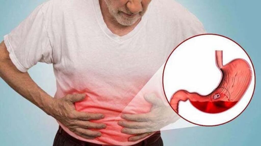 Đau bụng dữ dội đột ngột có phải thủng ổ loét dạ dày không?