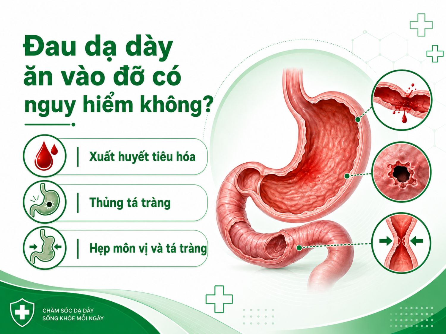 Đau dạ dày giảm sau khi ăn không nên chủ quan, đặc biệt nếu lặp lại nhiều lần hoặc kèm dấu hiệu bất thường. Tình trạng kéo dài có thể liên quan đến loét tá tràng và một số biến chứng cần được thăm khám sớm.