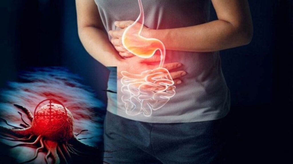 9 Dấu hiệu cảnh báo ung thư dạ dày không nên chủ quan