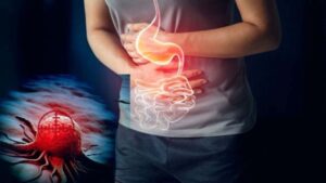 9 Dấu hiệu cảnh báo ung thư dạ dày không nên chủ quan