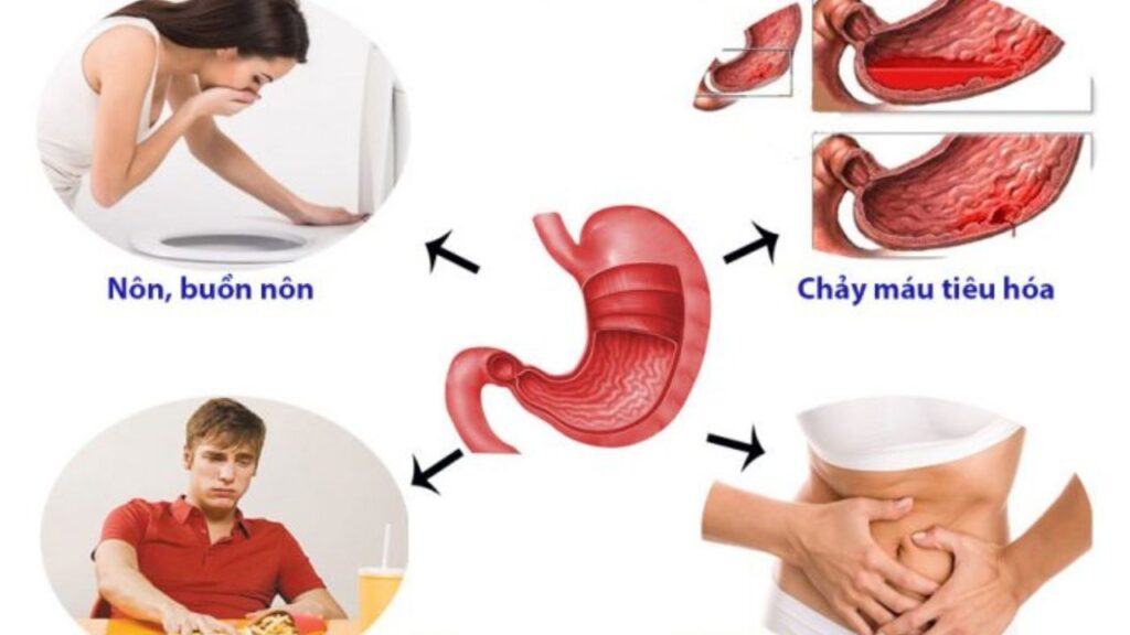 6 Dấu hiệu viêm dạ dày dễ nhận biết nhất