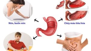 6 Dấu hiệu viêm dạ dày dễ nhận biết nhất