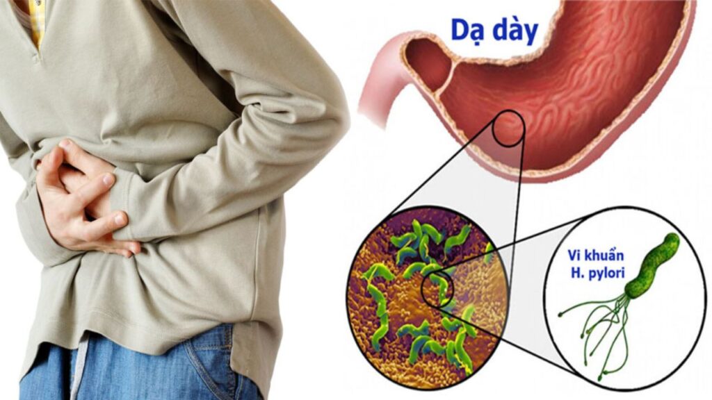 5 Dấu hiệu nhiễm vi khuẩn HP dạ dày dễ nhận biết và cách chẩn đoán chính xác