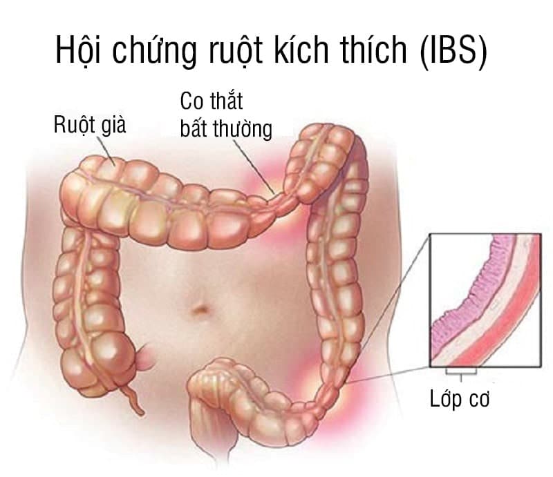 Hội chứng ruột kích thích gây sụt cân, sốt kéo dài bất thường