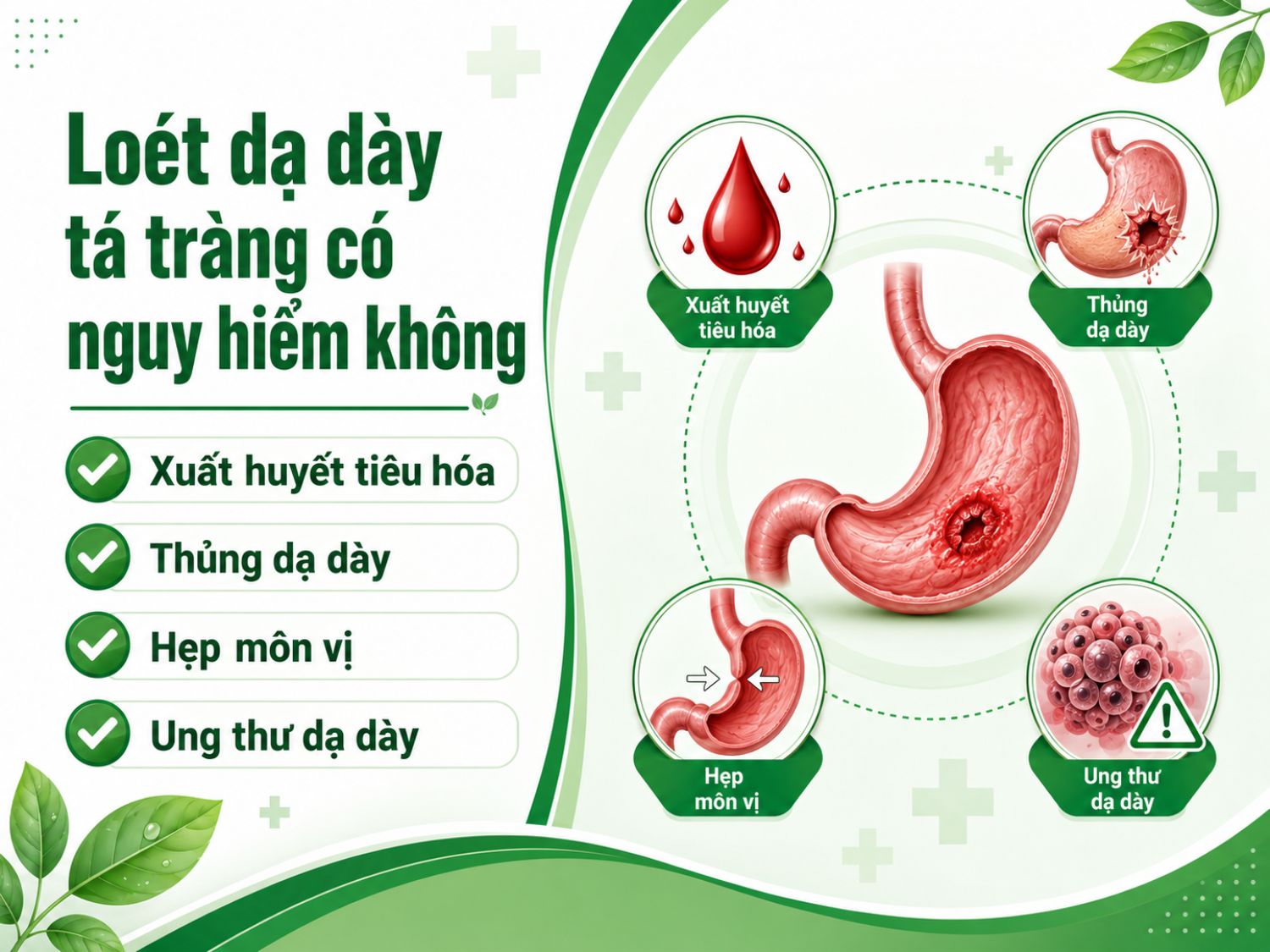 Loét dạ dày tá tràng không nên chủ quan vì bệnh có thể tiến triển thành xuất huyết tiêu hóa, thủng dạ dày, hẹp môn vị hoặc làm tăng nguy cơ ung thư dạ dày nếu không được điều trị đúng cách.