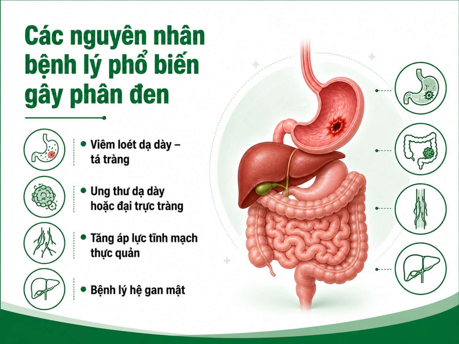 Phân đen kéo dài có thể liên quan đến xuất huyết tiêu hóa hoặc các bệnh lý tại dạ dày, tá tràng, đại trực tràng, thực quản và gan mật. Người bệnh nên đi khám sớm nếu phân đen đi kèm đau bụng, mệt mỏi, chóng mặt hoặc nôn ra máu.