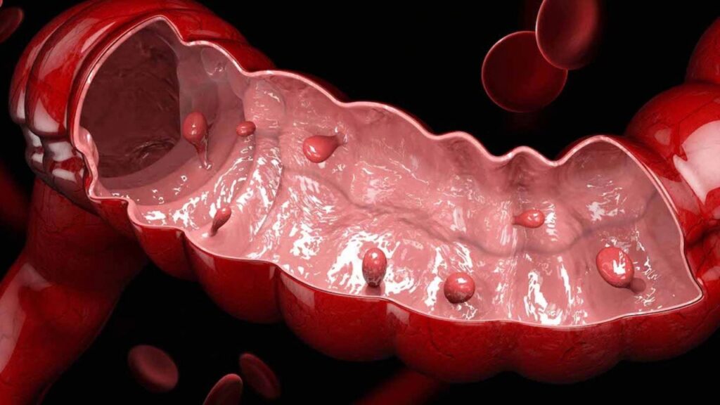 Polyp đại trực tràng là gì? Nguyên nhân, dấu hiệu và cách xử lý