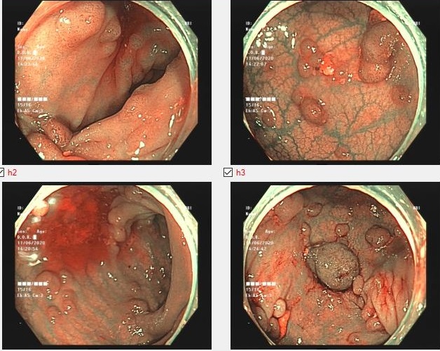 Nhiều Polyp xuất hiện ở đại tràng