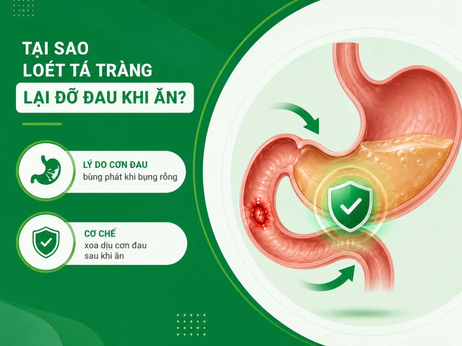 Loét tá tràng có thể đau rõ hơn khi bụng rỗng vì axit và co bóp dạ dày dễ kích thích ổ loét. Sau khi ăn, thức ăn tạo lớp đệm tạm thời nên cơn đau có thể dịu lại.