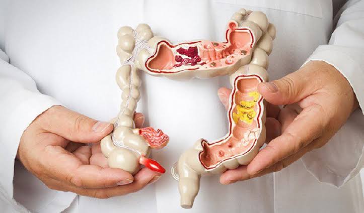 Tình trạng táo bón kéo dài, phân vón cục là dấu hiệu mạn tính