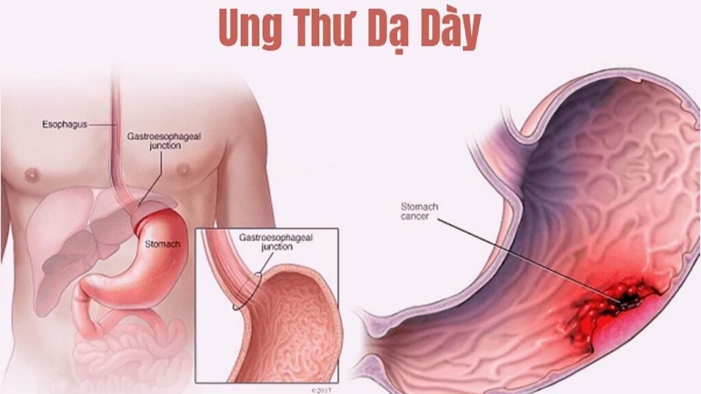 Ung thư dạ dày là gì? Dấu hiệu, nguyên nhân và cách phát hiện sớm