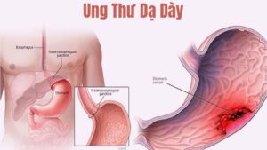 Ung thư dạ dày là gì? Dấu hiệu, nguyên nhân và cách phát hiện sớm