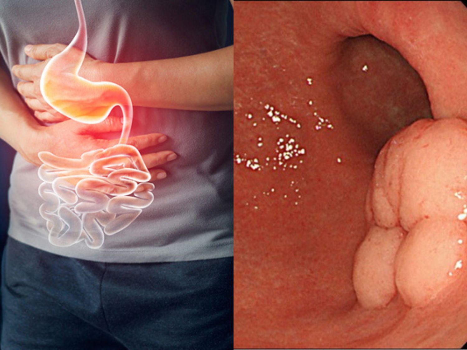 Những người gia đình có tiền sử mắc ung thư dạ dày, người nhiễm vi khuẩn HP
