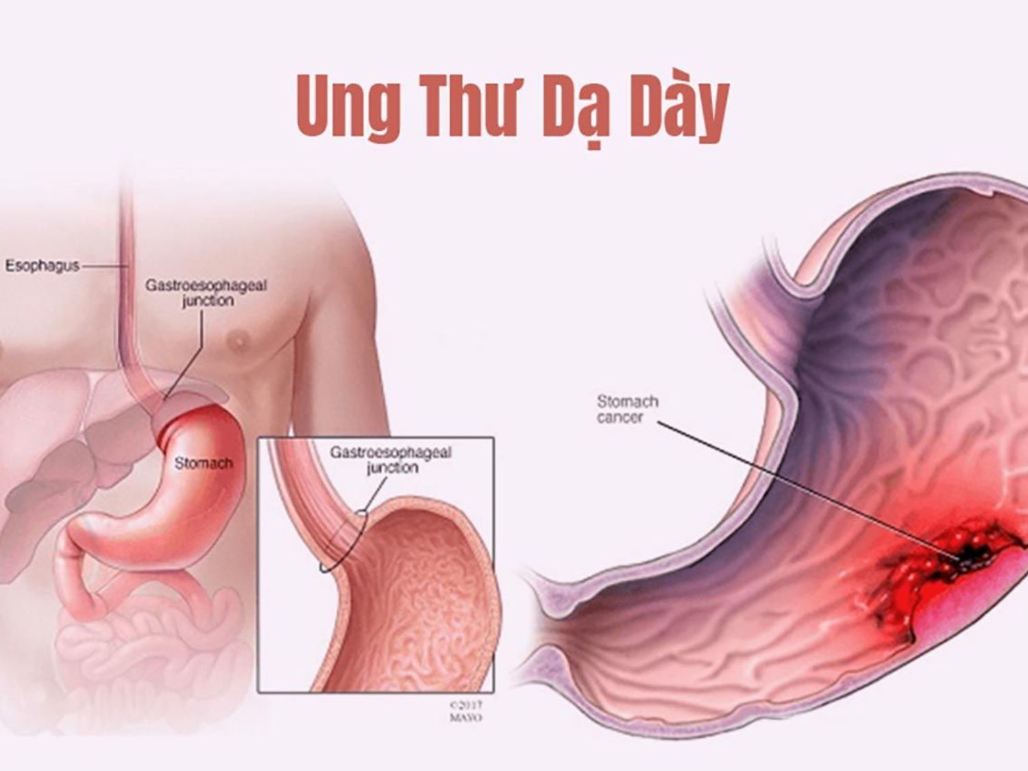 Ung thư dạ dày xuất hiện tế bào ở niêm mạc dạ dày tăng sinh bất thường