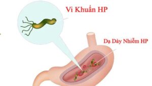Vi khuẩn HP dạ dày là gì và lây qua đường nào? Có nguy hiểm không