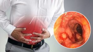 Viêm đại tràng mạn tính có chữa khỏi được không?