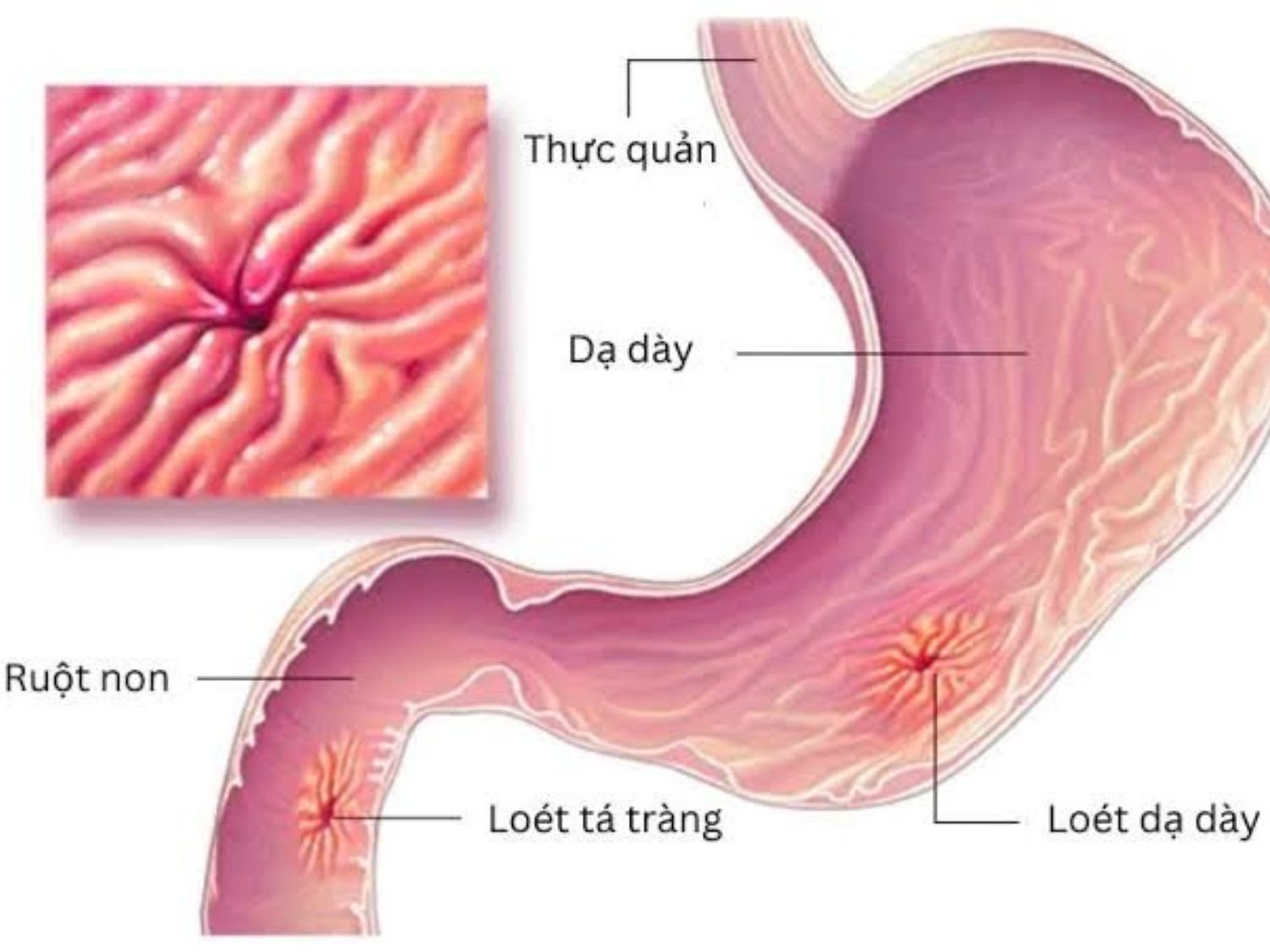 Loét dạ dày gây ra các tổn thương, gây đau vùng thượng vị