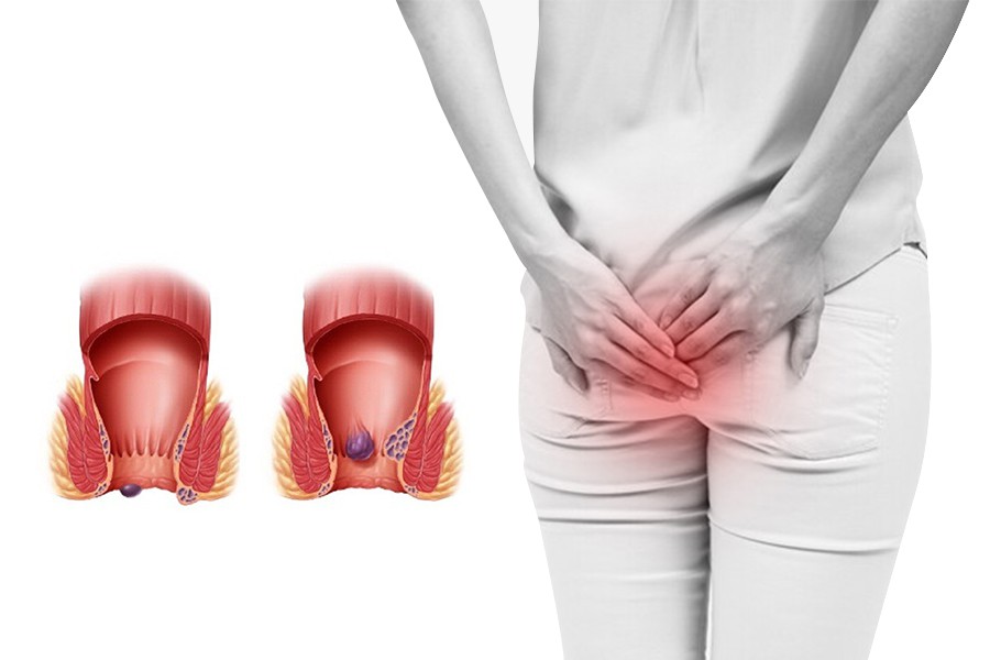 Bệnh trĩ gây khó chịu cho người bệnh