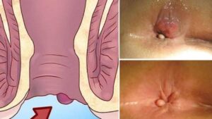 Bệnh trĩ có tự khỏi được không hay cần điều trị?
