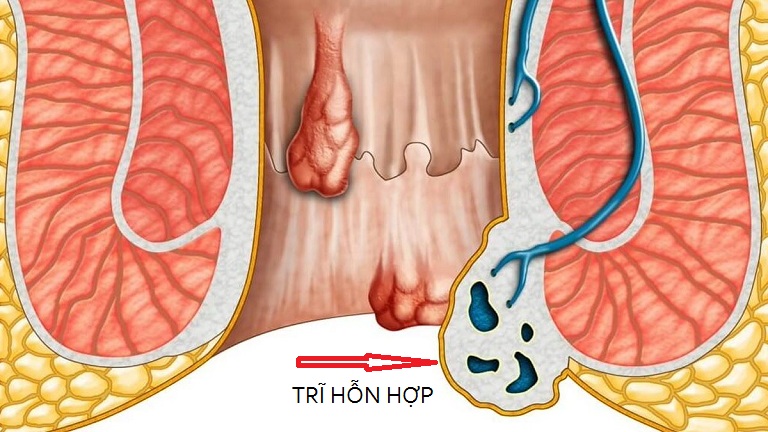 Trĩ hỗn hợp là tình trạng người bệnh đồng thời mắc trĩ nội và trĩ ngoại, khi búi trĩ phát triển và liên kết với nhau tạo thành tổn thương phức tạp hơn.