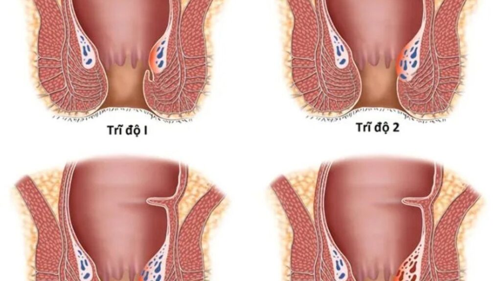 Bệnh trĩ là gì và có nguy hiểm không? Nguyên nhân và cách điều trị