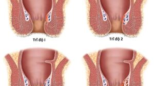 Bệnh trĩ là gì và có nguy hiểm không? Nguyên nhân và cách điều trị