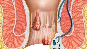 Trĩ nội là gì và dấu hiệu nhận biết ra sao? Hướng dẫn nhận biết sớm