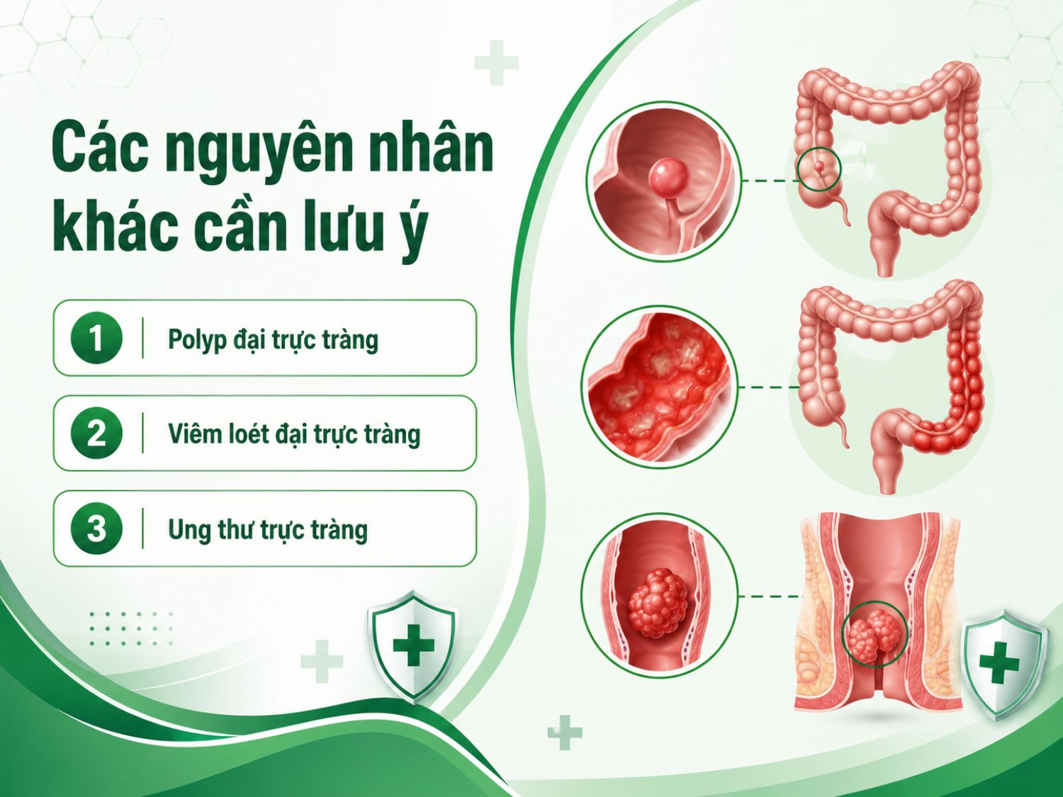 Đi ngoài ra máu không chỉ do trĩ hoặc nứt kẽ hậu môn mà còn có thể liên quan đến polyp, viêm loét đại trực tràng hoặc ung thư trực tràng.