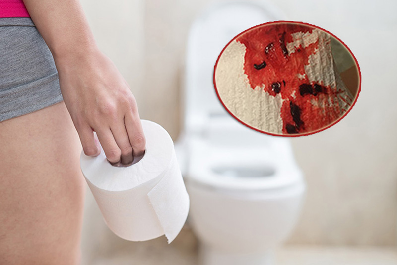 Đi ngoài kèm máu là dấu hiệu bất thường