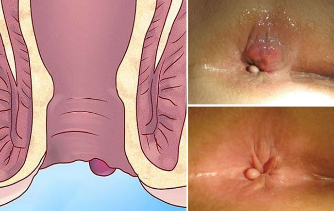Búi trĩ có thể sa ra ngoài hậu môn khi bệnh tiến triển, đôi khi kèm chảy máu, sưng đau hoặc khó chịu khi đại tiện.