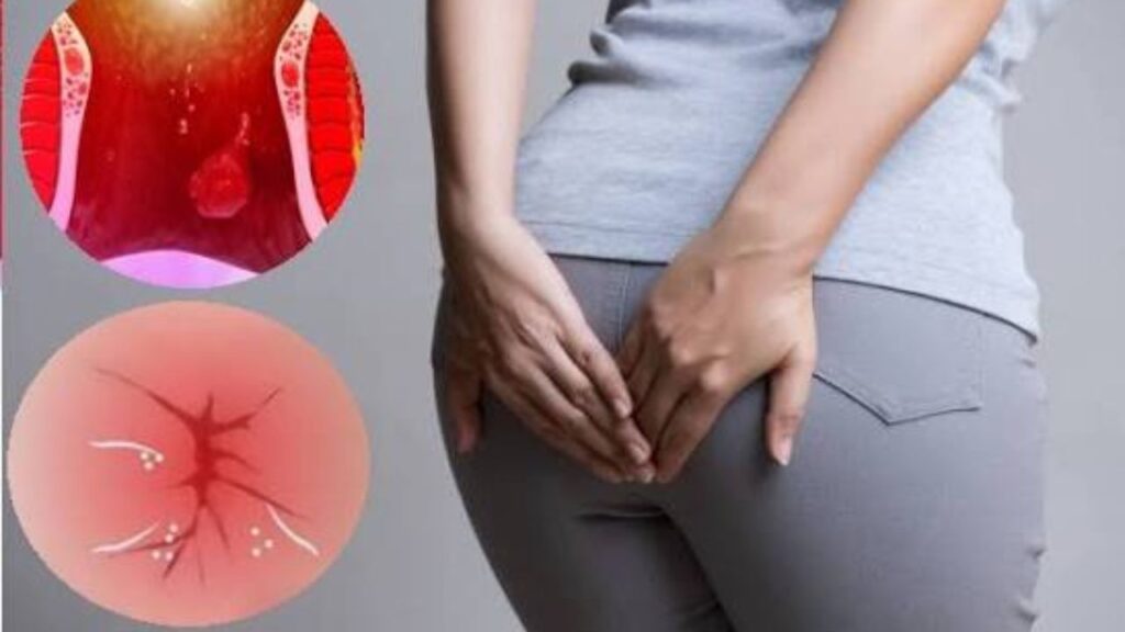 Ngứa rát hậu môn có phải dấu hiệu bệnh trĩ không?