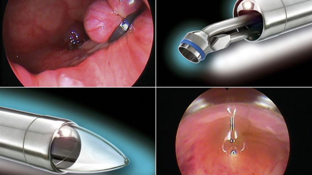 Nội soi trực tràng có phát hiện bệnh trĩ không? Giải đáp từ chuyên gia Tiêu Hóa Việt