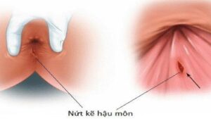 Nứt kẽ hậu môn là gì và có nguy hiểm không?