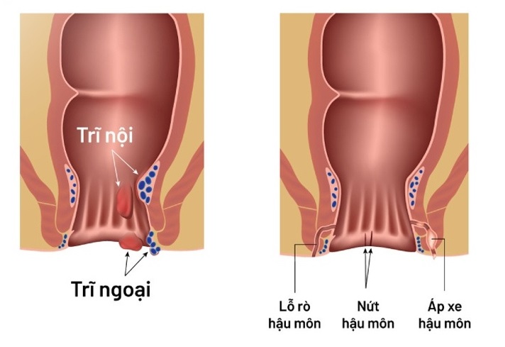 Trĩ và nứt kẽ hậu môn có cách nhận biết khác nhau