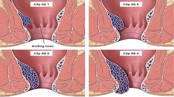 Trường hợp sa búi trĩ cần điều trị qua từng cấp độ