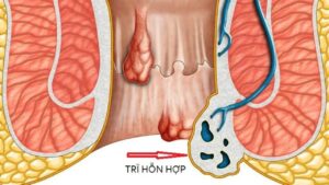 Trĩ hỗn hợp là gì và điều trị như thế nào?