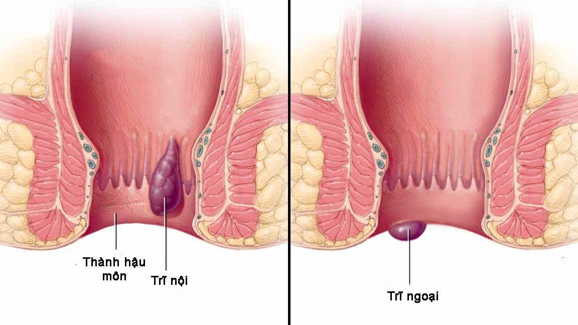 Trĩ nội hình thành bên trong ống hậu môn, trong khi trĩ ngoại xuất hiện dưới da quanh hậu môn. Việc phân biệt giúp lựa chọn phương pháp điều trị phù hợp.