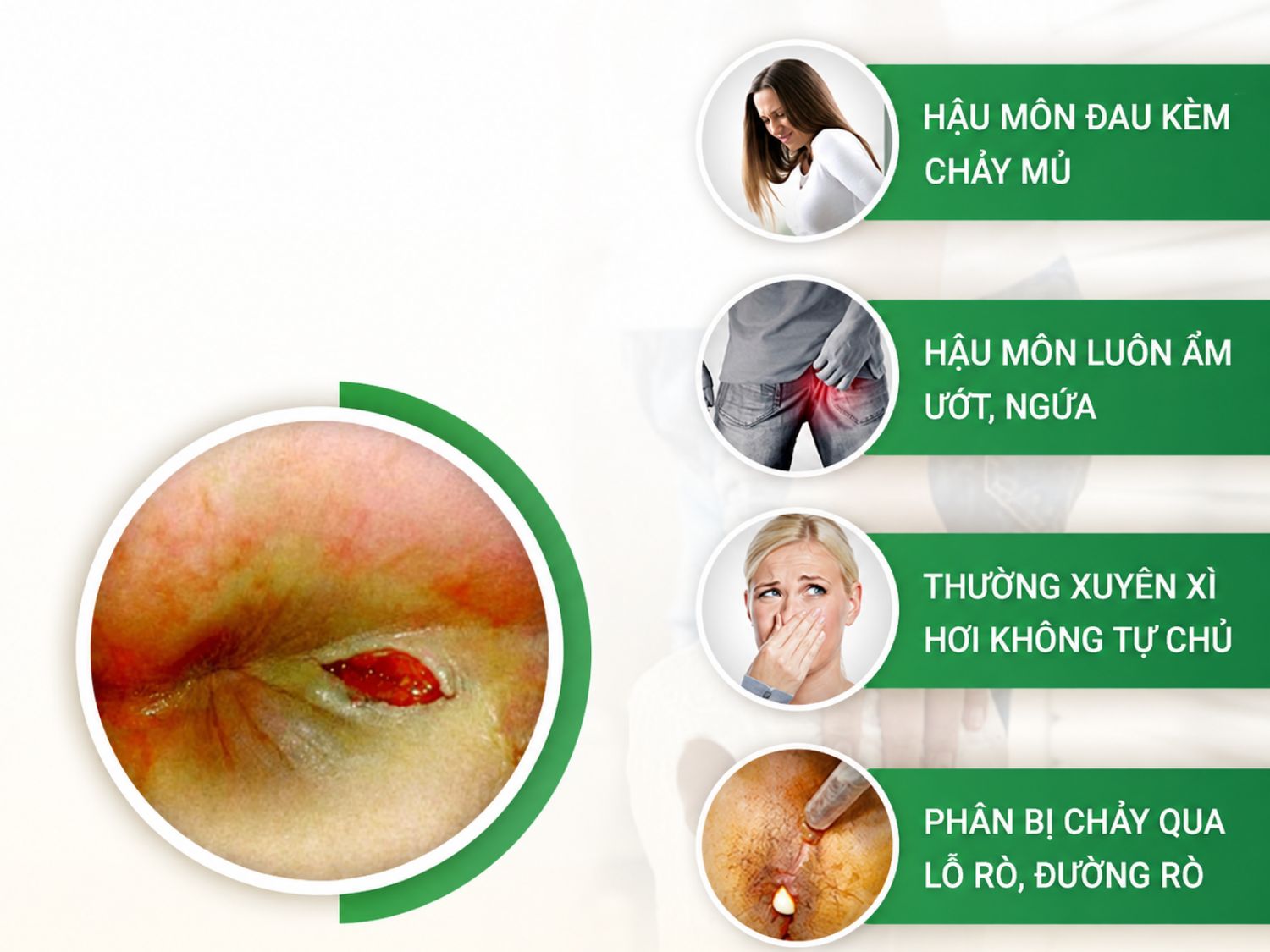 Rò hậu môn có thể biểu hiện bằng tình trạng đau, chảy mủ, ngứa ẩm kéo dài hoặc xuất hiện dịch, phân thoát qua đường rò. Khi có các dấu hiệu này, người bệnh nên thăm khám sớm để xác định mức độ tổn thương và có hướng điều trị phù hợp.