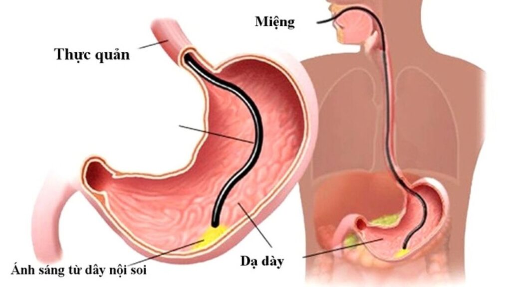 Nội soi dạ dày giá bao nhiêu tiền năm 2026? Chi phí thực tế và các khoản cần chuẩn bị