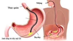 Nội soi dạ dày giá bao nhiêu tiền năm 2026? Chi phí thực tế và các khoản cần chuẩn bị