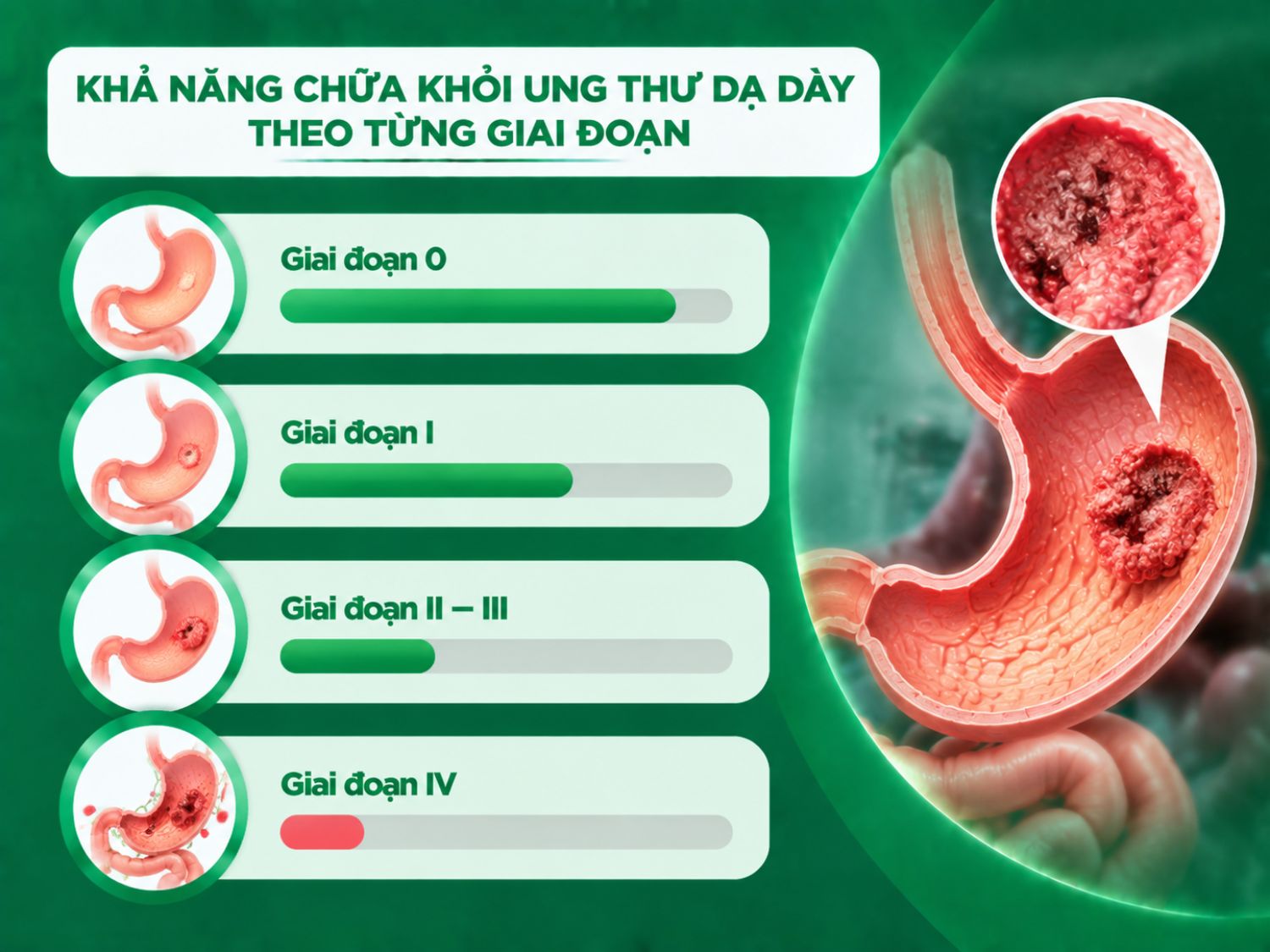 Khả năng điều trị ung thư dạ dày phụ thuộc vào nhiều yếu tố như giai đoạn ung thư, mức độ xâm lấn của khối u, tình trạng hạch, khả năng di căn xa, đặc điểm mô bệnh học – sinh học phân tử và thể trạng người bệnh để bác sĩ lựa chọn phác đồ phù hợp.