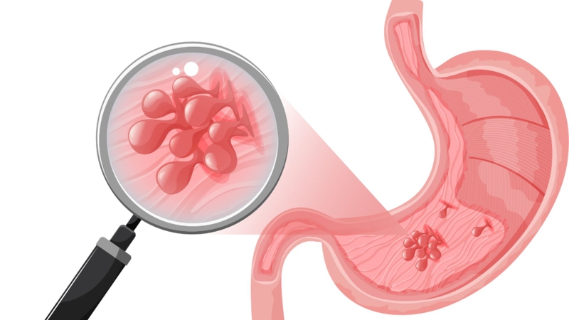 Hình polyp trong lòng dạ dày với vùng tổn thương được phóng đại để quan sát rõ hơn.