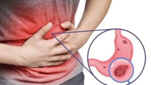 Loét dạ dày tá tràng là gì, khác viêm dạ dày thế nào?