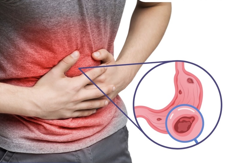 Tình trạng đau dạ dày dữ dội kéo dài kèm theo buồn nôn, nôn nhiều