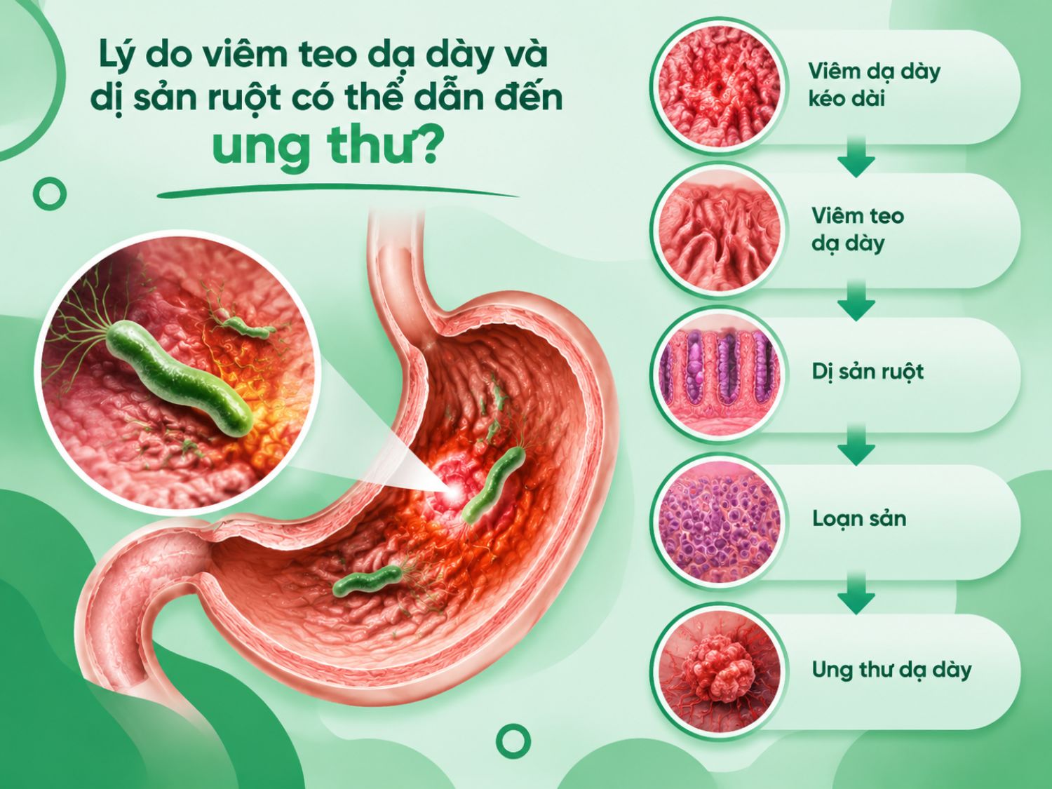 Viêm teo dạ dày, dị sản ruột có phải tiền ung thư không?